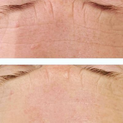 skinbase microdermabrasion facial treatment before and after picture Nataya Beauty Manchester City centre