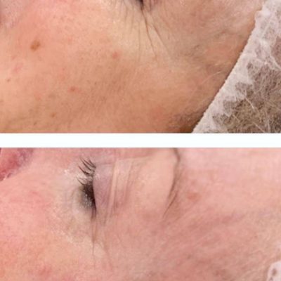 skinbase microdermabrasion facial treatment before and after picture Nataya Beauty Manchester City centre