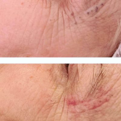 skinbase microdermabrasion facial treatment before and after picture Nataya Beauty Manchester City centre
